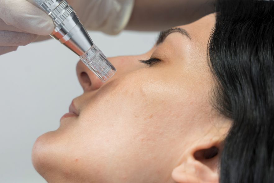 Facial treatment with micro-needling device