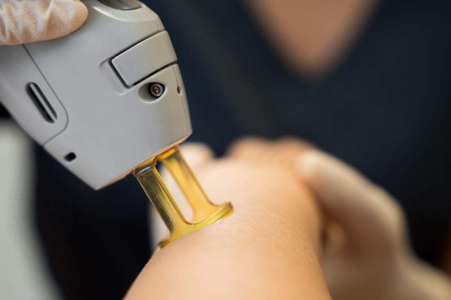 Candela Alexandrite Laser